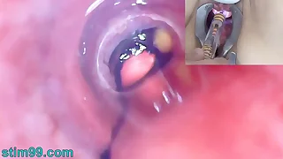 Mature Woman Peehole Endoscope Camera nearly Bladder all round Blather